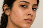 How To Remove Acne Marks & Dark Spots Naturally Without Damaging Your Skin