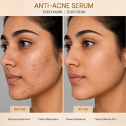 Migen Anti-Acne Serum